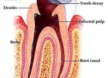 Endodontics Treatment Course in Mumbai – Your Gateway to Mastering Root Canal Excellence